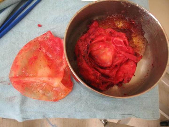 A photograph of a reddish mass in a small metal bowl. Surrounding the mass are what appear to be an explanted scar tissue capsule and some gel from a breast implant. Part of the breast implant is on a surface next to the metal bowl.