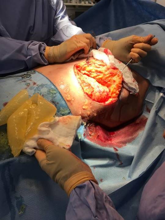 A photograph of a surgical procedure. A patient lies on an operating table with torso exposed. The patient has an opening in the skin where the left breast implant has been removed. A surgeon uses metal surgical tools to lift up the tissue under the left breast to show silicone in the patient’s body following implant rupture. A hand in the foreground holds a white gauze, on top of which rests the shell of the ruptured implant.
