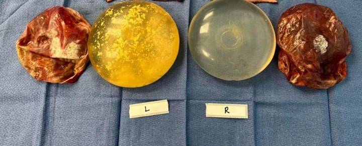 A photograph of two breast implants and two scar capsules on a blue cloth. The left implant is bright yellow and has marks indicating debris. In contrast, the right implant is mostly transparent.