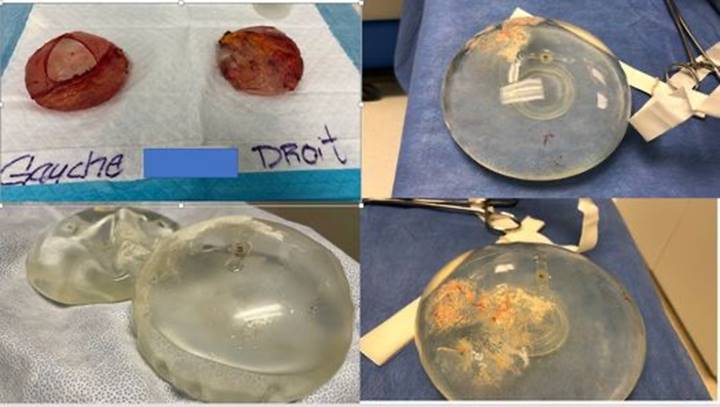 This figure is a composite of four photographs. The top left image shows two breast implants, each covered in a reddish scar capsule. The bottom left image shows two breast implants that appear to be partially depleted of saline. The top right image shows a single breast implant that has discolouration on a part of its surface. The bottom right image shows a different angle of the same implant, with a closer view of the discolouration on the surface.